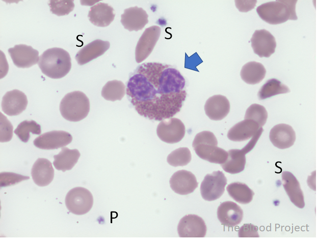 Eosinophils • The Blood Project