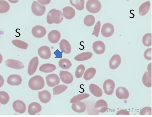 Howell-Jolly Bodies • The Blood Project