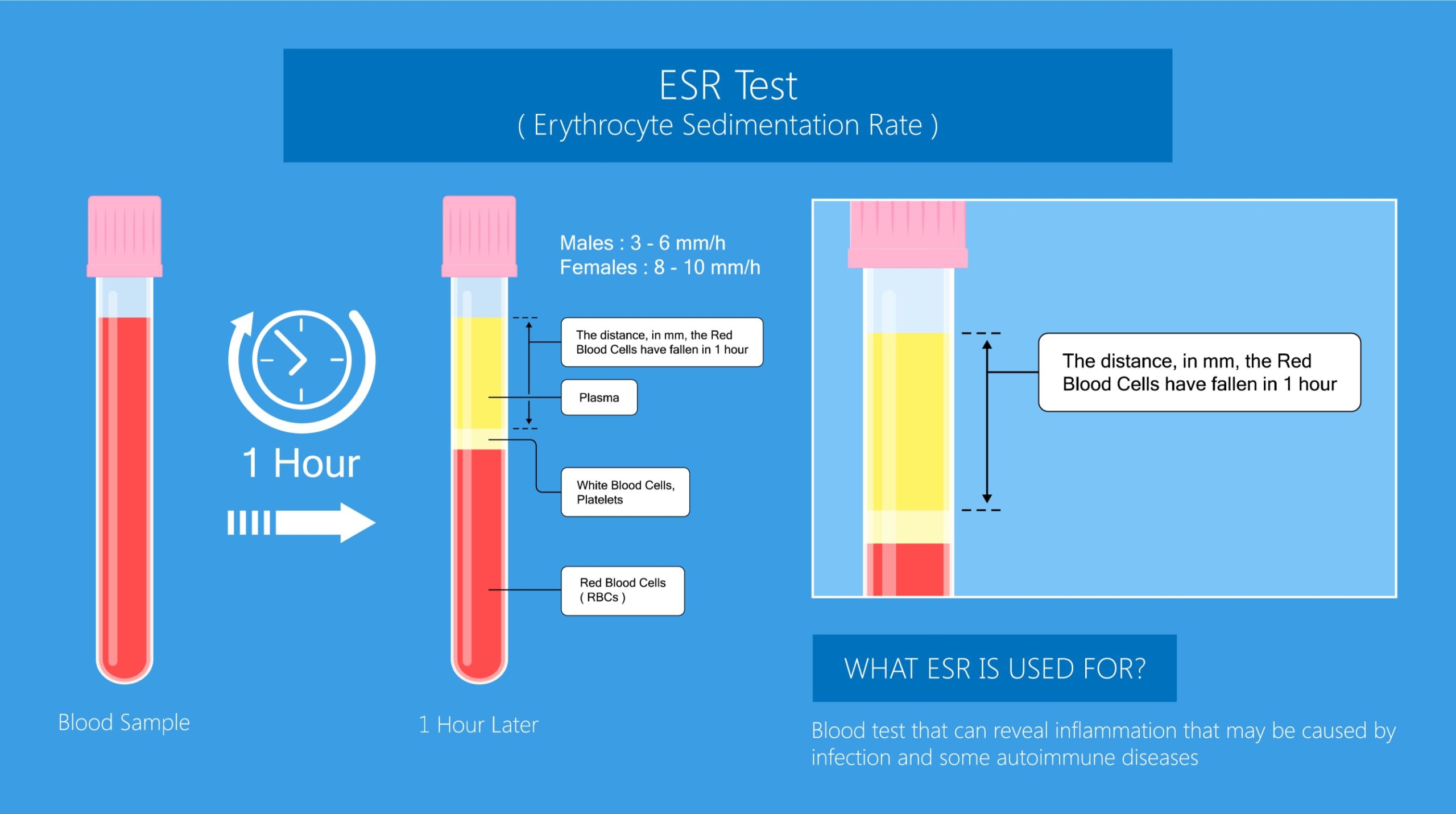 Erythrocyte sedimentation rate (ESR) solution and procedure