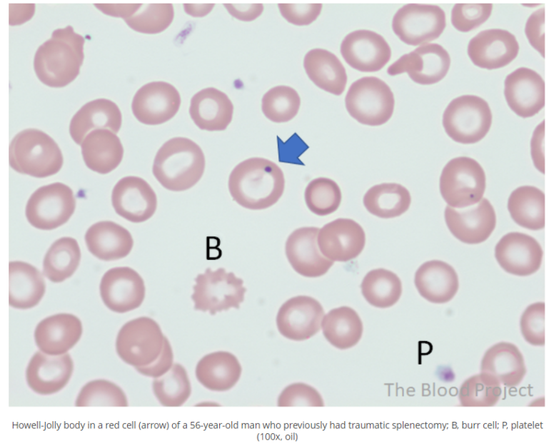 What is a Howell-Jolly body? • The Blood Project