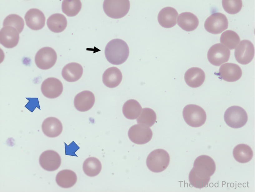 Warm Autoimmune Hemolytic Anemia The Blood Project