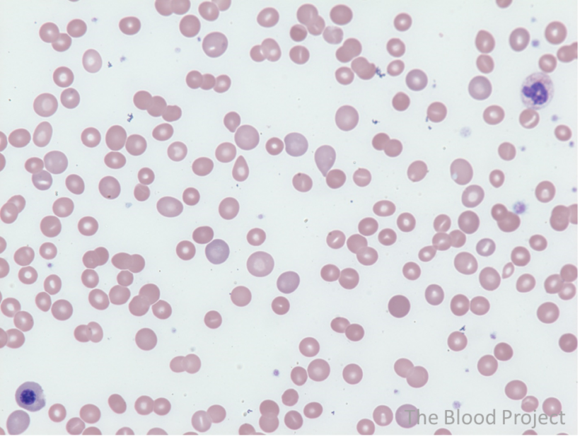 Warm Autoimmune Hemolytic Anemia • The Blood Project