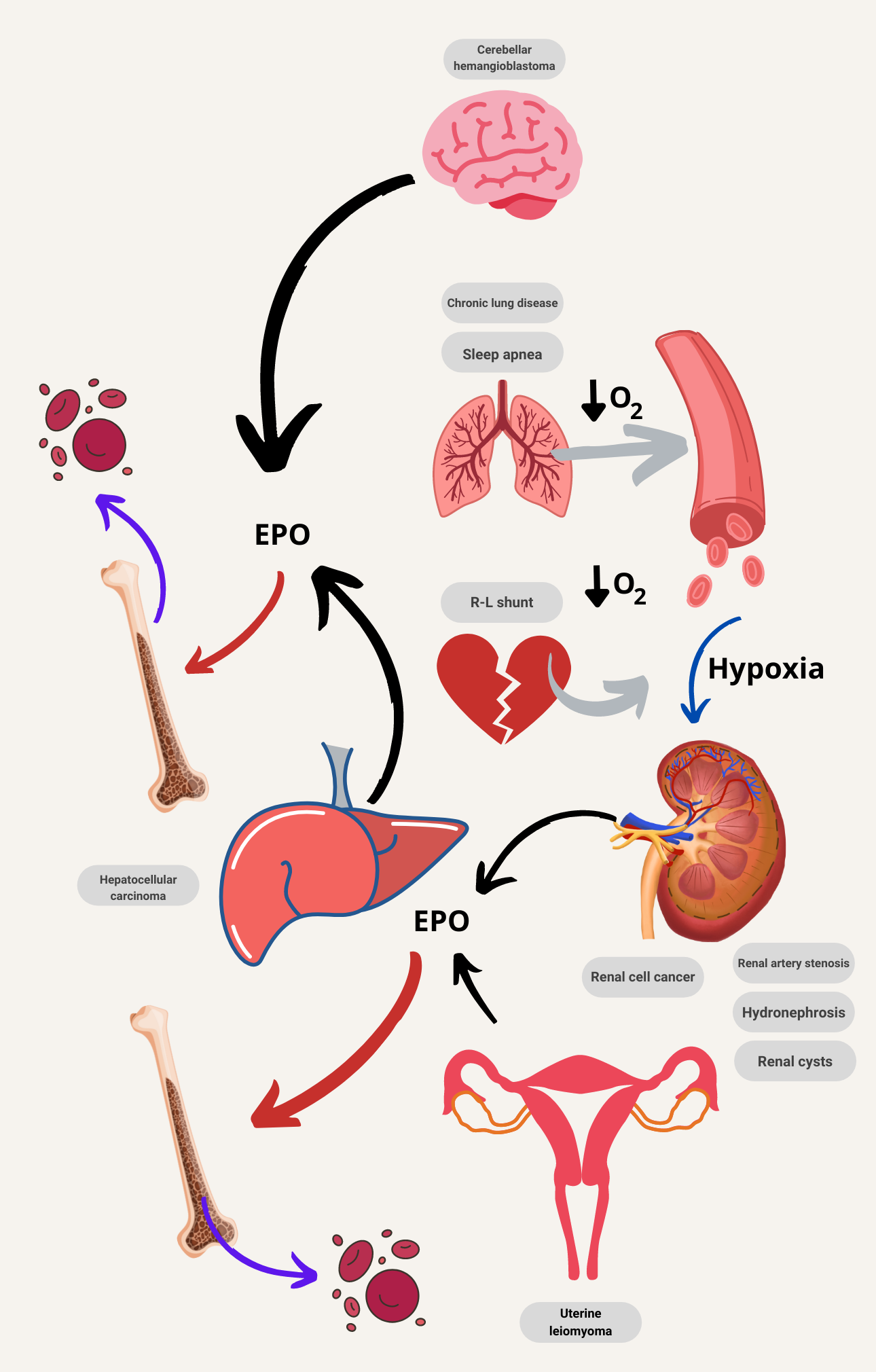 polycythemia-erythrocytosis-differential-diagnosis-the-blood-project