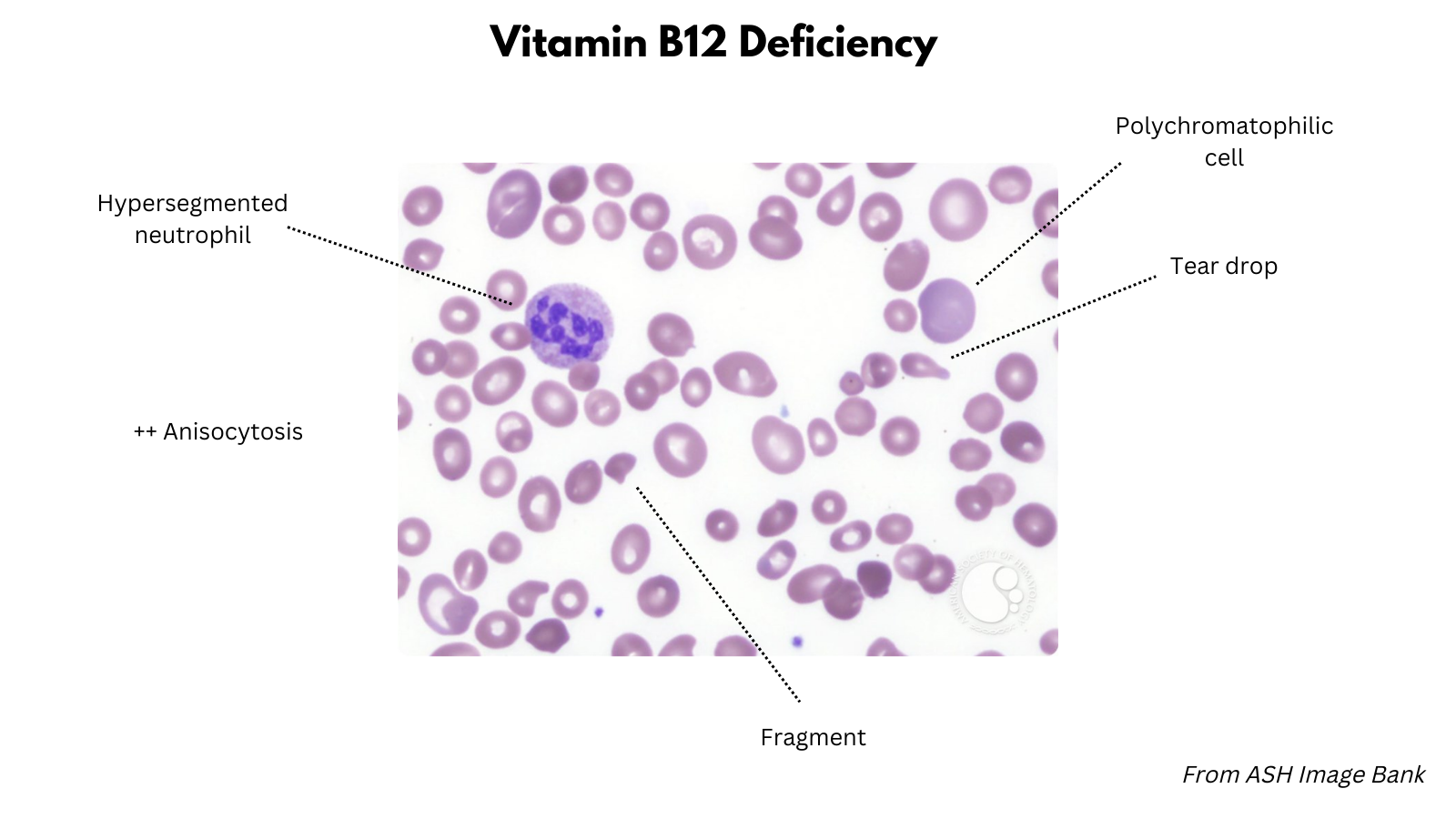 Macrocytic Anemias • The Blood Project