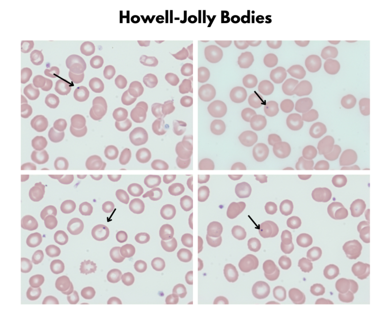 Red Cell Inclusions • The Blood Project