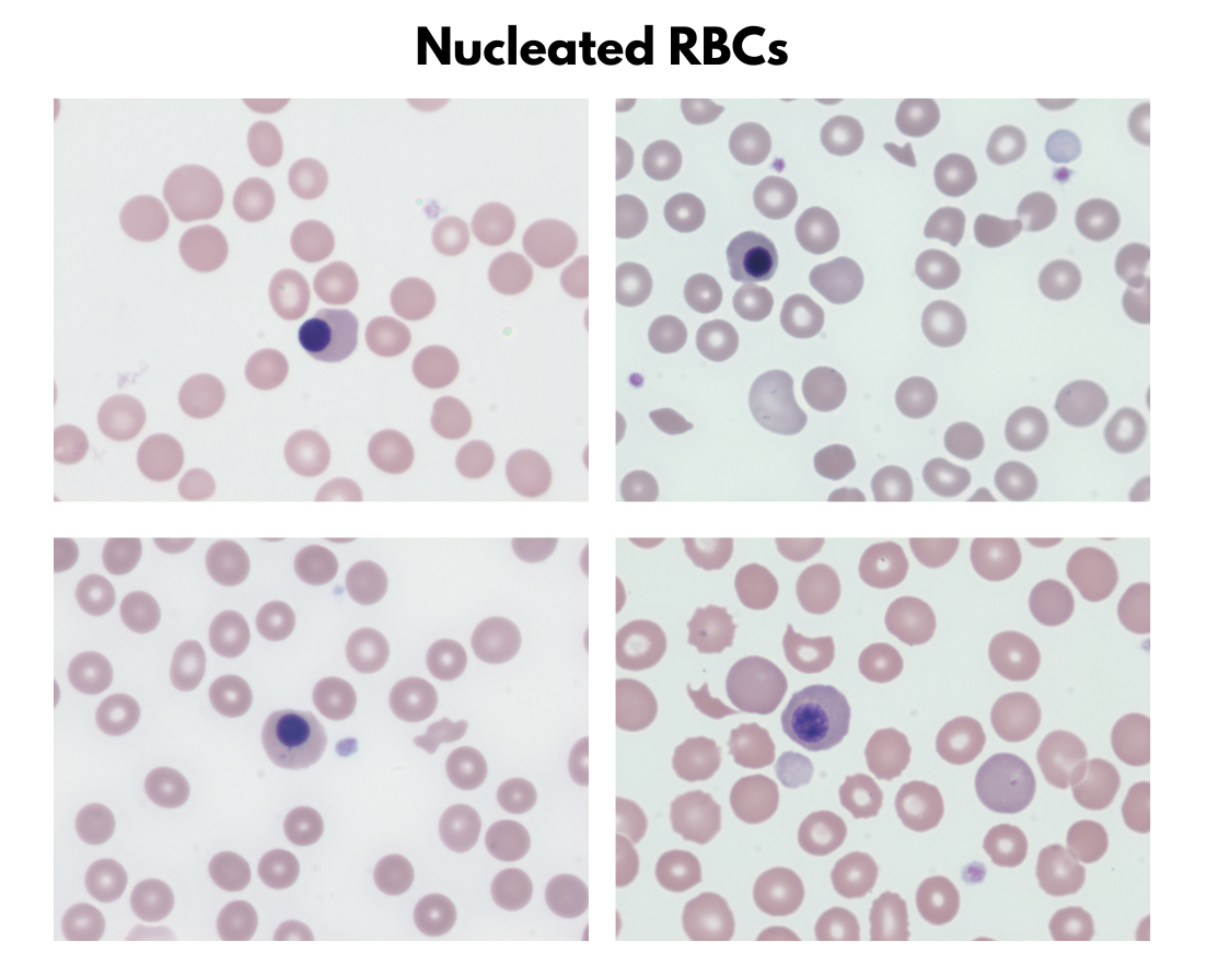 Red Cell Inclusions The Blood Project